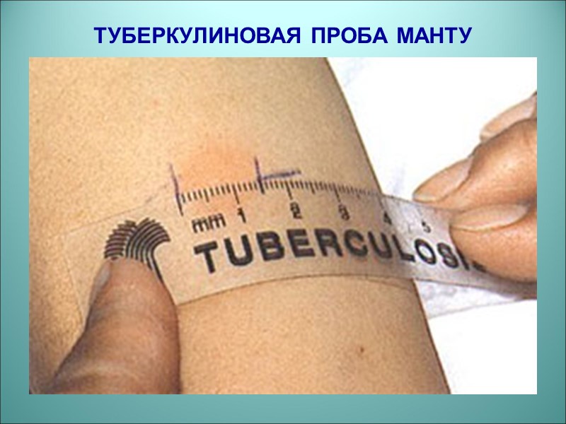 ТУБЕРКУЛИНОВАЯ ПРОБА МАНТУ